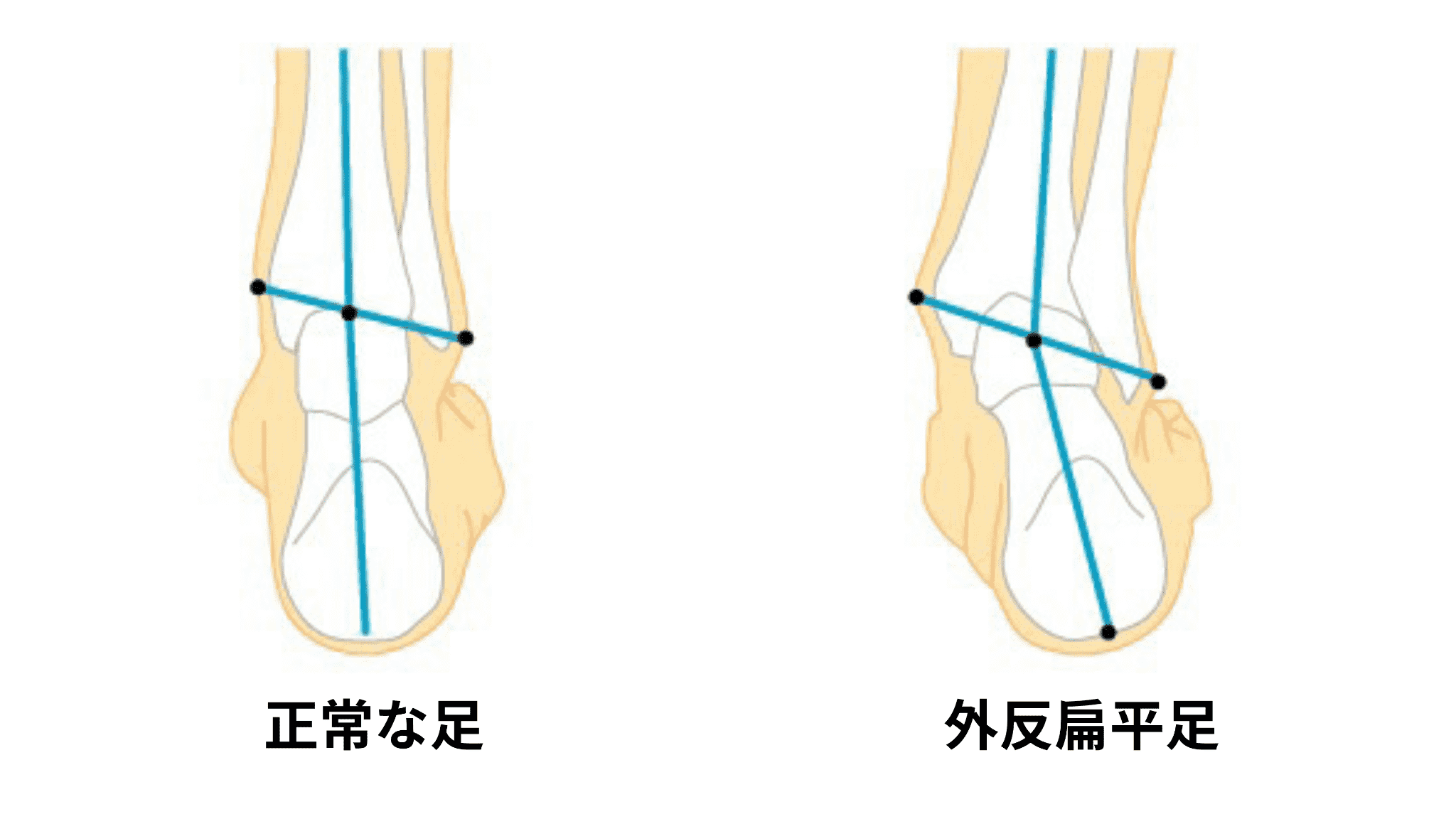 正常な足と外反扁平足